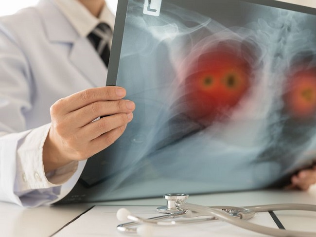 Agilent Technologies Obtains CE Mark for Expanded Use of PD-L1 CDx in NSCLC